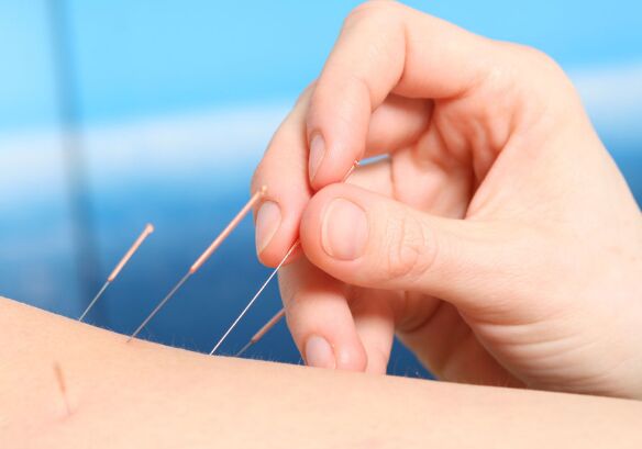 針灸減肥有副作用嗎 研究表明存在副作用