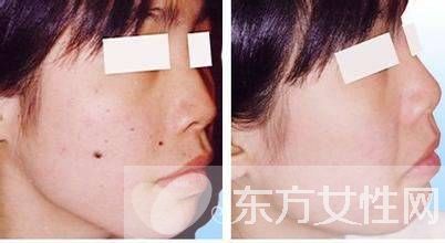 點痣后的注意事項須知 五要點需做好