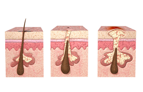 毛周角化癥是怎么回事 一種遺傳性皮膚病