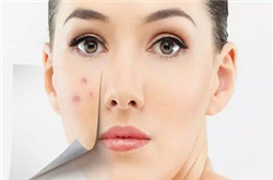 臉部祛痘的方式方法