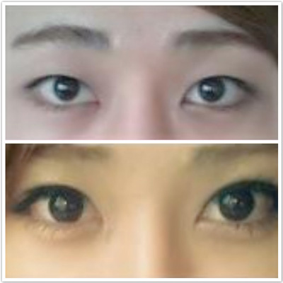 做雙眼皮的后遺癥 會(huì)留下疤痕