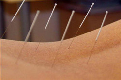 針灸減肥有副作用嗎 研究表明存在副作用