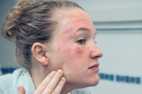 治療皮膚過(guò)敏偏方   五種偏方有奇效