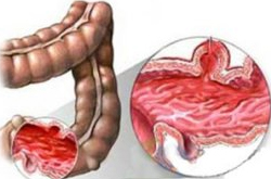 清晰病癥 4種中醫(yī)直腸炎的治療方法