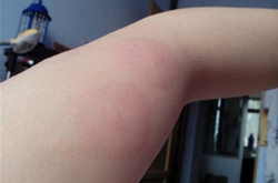 慢性蕁麻疹怎么辦 治療慢性蕁麻疹的偏方