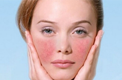 紅血絲皮膚怎么辦 如何治療皮膚有紅血絲