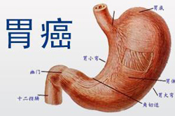 胃癌晚期癥狀與飲食禁忌介紹