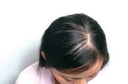 影響形象 斑禿最好的治療方法介紹