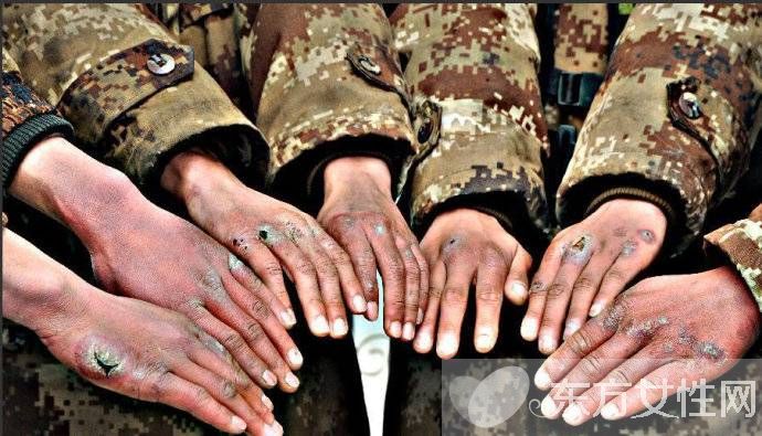 怎么治凍瘡 幾招教你怎樣預(yù)防凍瘡