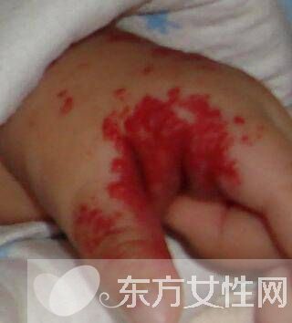 紅胎記是什么 胎記怎么去除