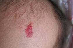 紅胎記是什么 胎記怎么去除