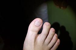 治療灰指甲偏方有哪些 注意事項(xiàng)不可忘