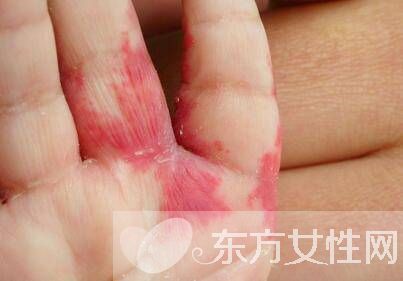 紅胎記是什么 胎記怎么去除