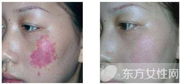 紅胎記是什么 胎記怎么去除
