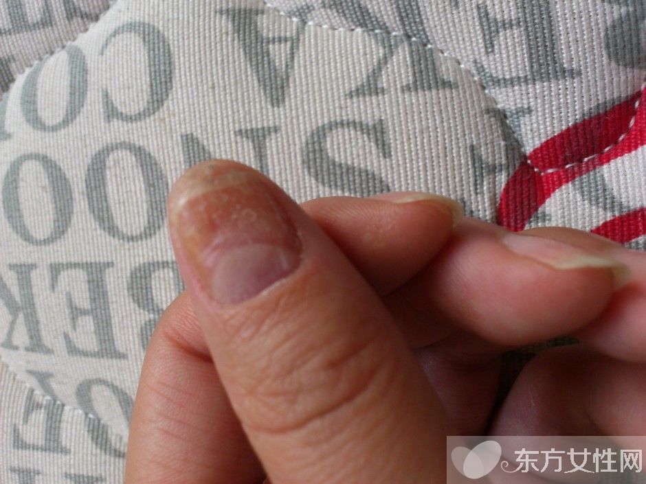 灰指甲會(huì)傳染嗎 灰指甲的護(hù)理方法