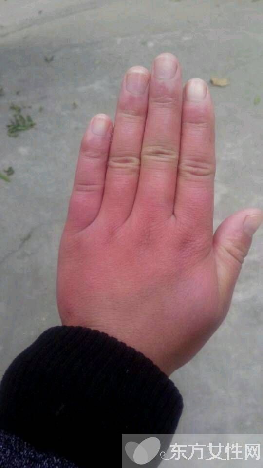 怎么治凍瘡 幾招教你怎樣預(yù)防凍瘡