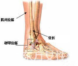 韌帶損傷如何治療 韌帶損傷的癥狀