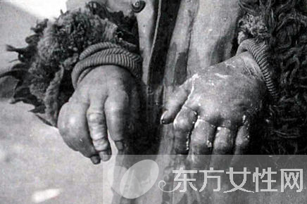 冬天凍傷怎么辦 凍傷兩大緊急處理辦法