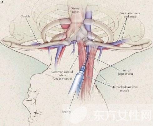 靜脈曲張怎么預(yù)防 靜脈曲張的病因是什么