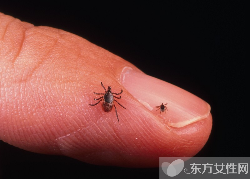 虱子咬的癥狀有哪些 怎樣去除虱子