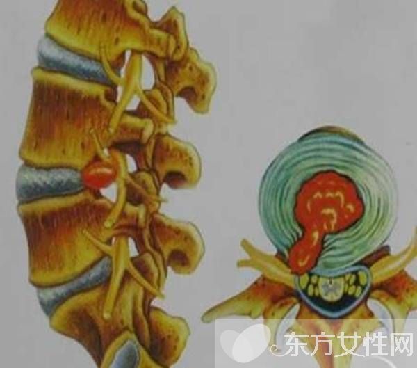 腰椎盤突出怎么鍛煉 腰椎盤突出的4大病因