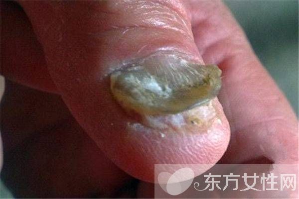 治療灰指甲偏方有哪些 注意事項不可忘