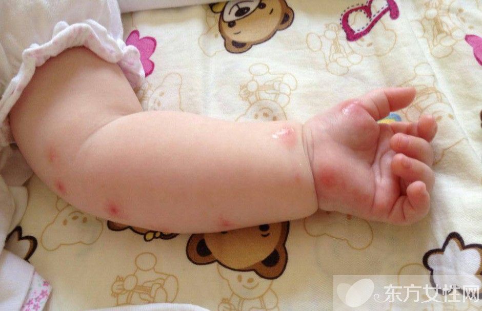 止癢的方法有哪些 常見的4大過敏源