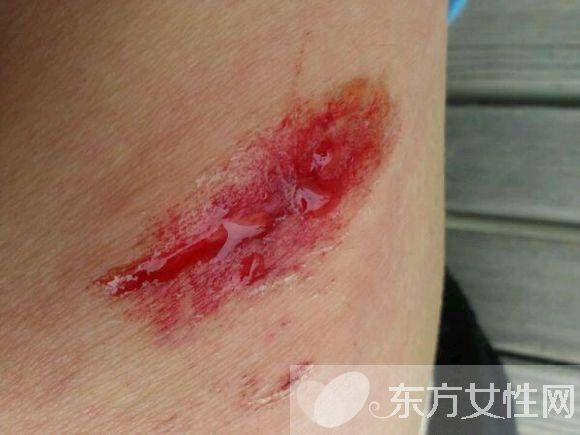 擦傷怎么自行處理 不同類型疤痕的治療方法