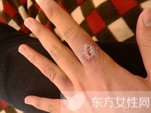 治療凍瘡的方法有哪些 8大方法幫你醫(yī)治