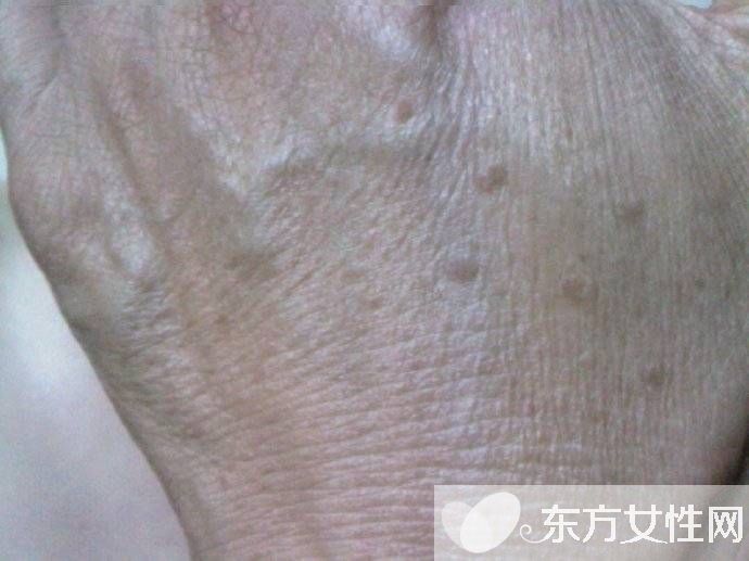 年輕人手上老年斑的原因