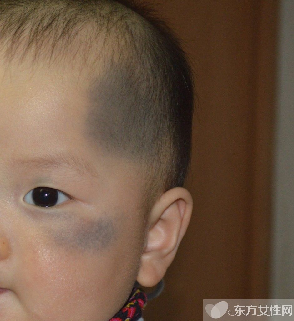 胎記是怎么形成的 胎記對命運也是有影響的哦