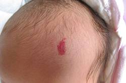 胎記怎么去除 激光去胎記的5大優(yōu)勢(shì)