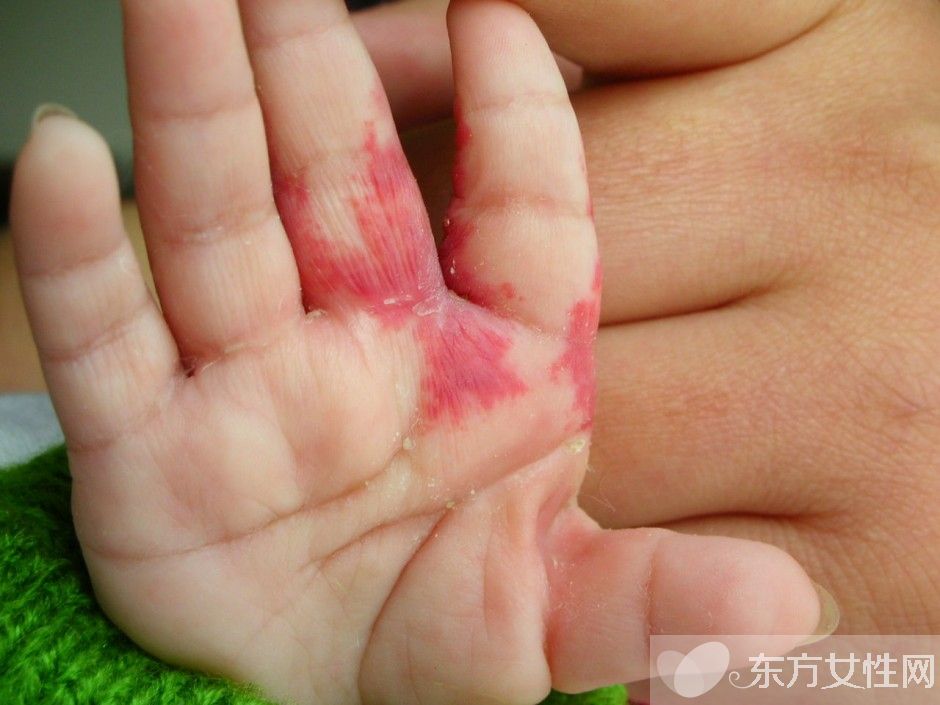 胎記是怎么形成的 胎記對命運也是有影響的哦