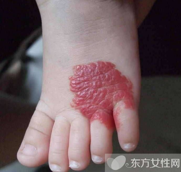 胎記是怎么形成的 胎記對命運也是有影響的哦