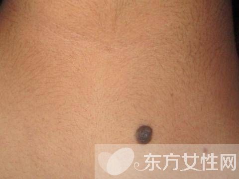 痣是怎么形成的 激光去痣后的6大護(hù)理方法