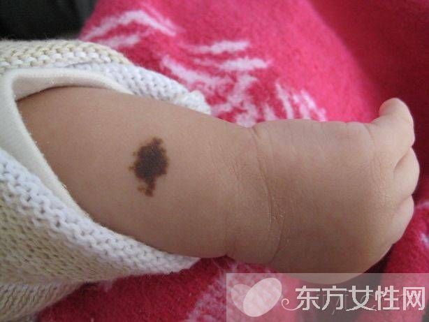 胎記怎么去除 激光去胎記的5大優(yōu)勢