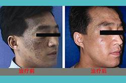 胎記是怎么形成的 怎么去除胎記