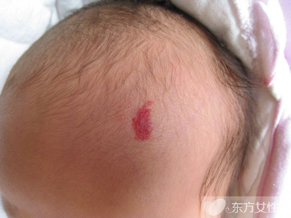 胎記的治療方法有哪些 胎記是怎么產(chǎn)生的