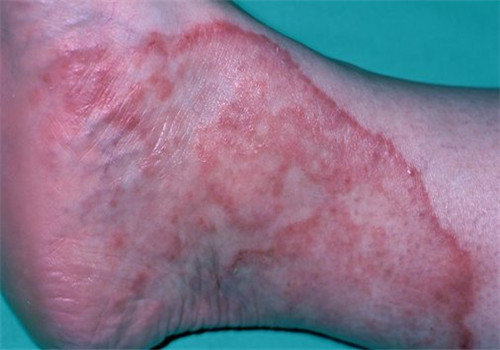 腳氣產(chǎn)生的原因 去除腳氣小編有辦法