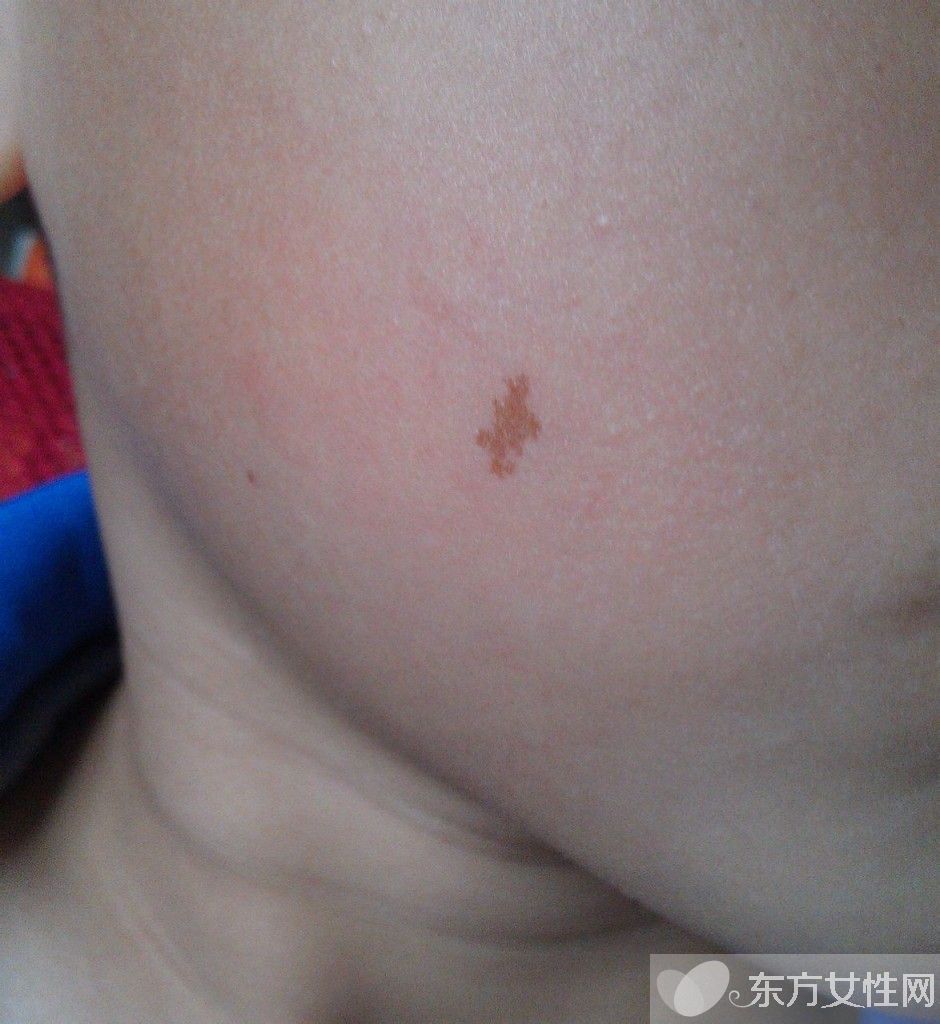 胎記是怎么形成的 胎記對命運也是有影響的哦