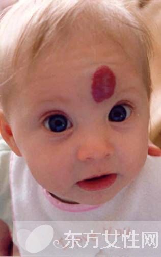 胎記的治療方法有哪些 胎記是怎么產(chǎn)生的