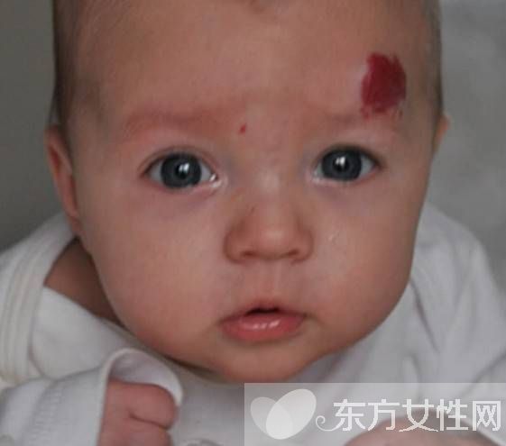 胎記是怎么形成的 怎么去除胎記