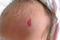 胎記是怎么形成的 胎記對命運也是有影響的哦