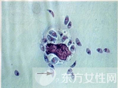 弓形蟲病的癥狀是什么 7大健康飲食教你預(yù)防