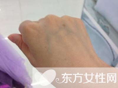 年輕人手上老年斑的原因