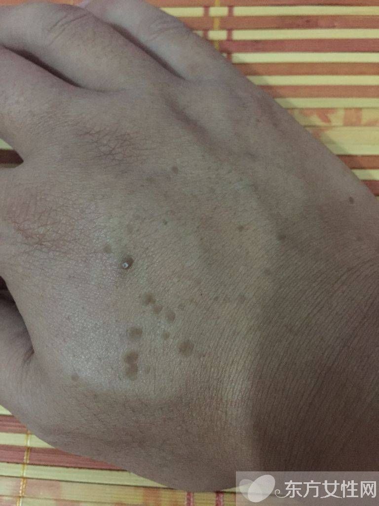 年輕人手上老年斑的原因