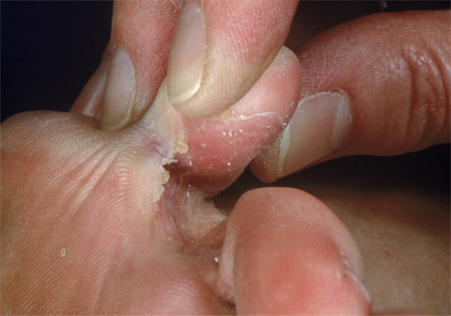 腳氣產(chǎn)生的原因 去除腳氣小編有辦法