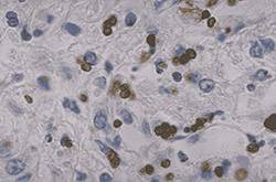 弓形蟲(chóng)病的癥狀是什么 7大健康飲食教你預(yù)防