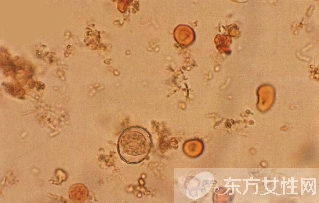 弓形蟲病的癥狀是什么 7大健康飲食教你預(yù)防