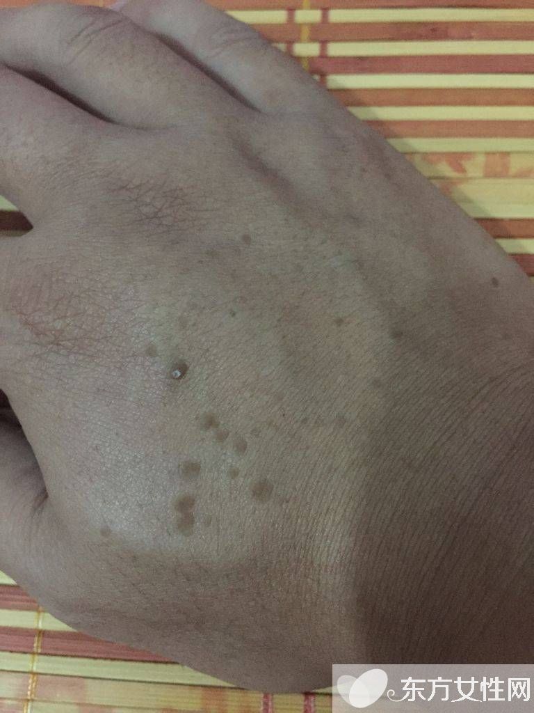 年輕人手上老年斑的原因